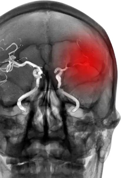 We're focused on ischemic stroke